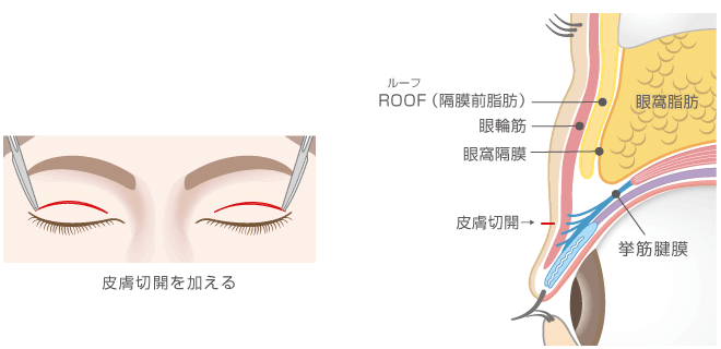 目の上脂肪 眼窩脂肪 Roof 除去 上眼瞼脱脂術 ヒルズ美容クリニックは神奈川 湘南 藤沢の美容外科 美容皮膚科 形成外科