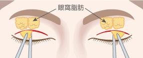眼窩脂肪除去術＋全切開による重瞼術2正面