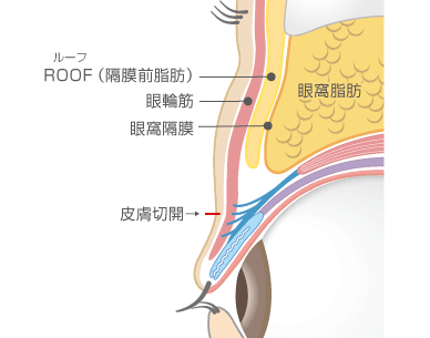ROOF除去術＋全切開による重瞼術1断面