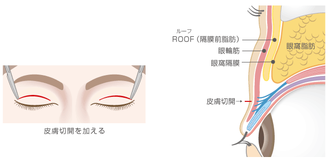 目の上脂肪 眼窩脂肪 Roof 除去 上眼瞼脱脂術 ヒルズ美容クリニックは神奈川 湘南 藤沢の美容外科 美容皮膚科 形成外科