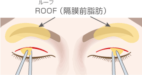 ROOF除去術＋全切開による重瞼術2正面