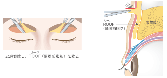 目の上脂肪 眼窩脂肪 Roof 除去 上眼瞼脱脂術 ヒルズ美容クリニックは神奈川 湘南 藤沢の美容外科 美容皮膚科 形成外科