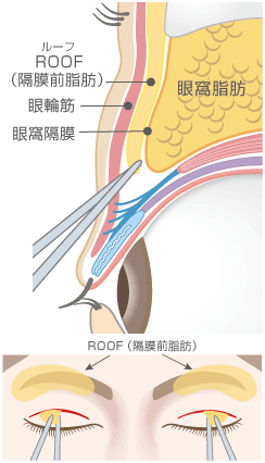 眼窩脂肪＋ROOF除去術＋全切開による重瞼術2断面