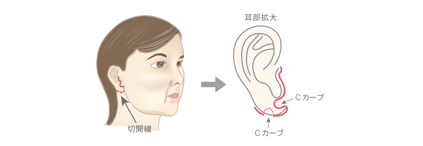 ミニリフトSMAS法の方法・手順:切開線をデザイン