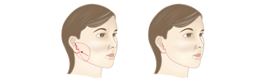 ミニリフトSMAS法の方法・手順:縫合