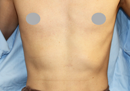 正面から見た肋軟骨の張り出し（施術前）