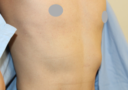 斜めから見た肋軟骨の張り出し（施術前）