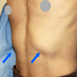 肋軟骨の張り出し