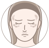 肝斑のイラスト