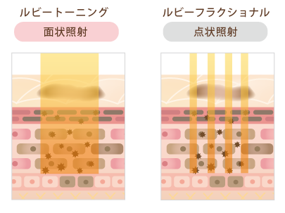 ルビートーニングとルビーフラクショナルの照射面の違い