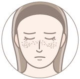 そばかすのイラスト