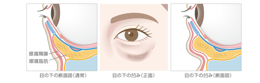 下眼瞼脂肪再置換 ハムラ法 ヒルズ美容クリニックは神奈川 湘南 藤沢の美容外科 美容皮膚科 形成外科
