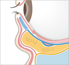 目の下の凹みの解剖図イラスト：目の下の凹み（断面図）