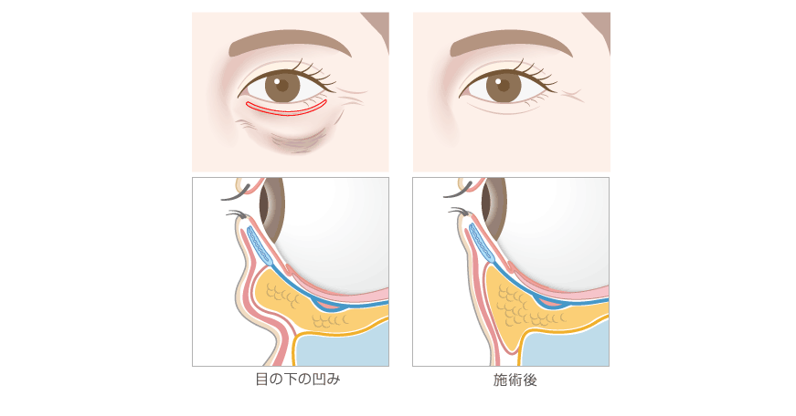 下眼瞼脂肪再置換 ハムラ法 ヒルズ美容クリニックは神奈川 湘南 藤沢の美容外科 美容皮膚科 形成外科