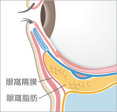 目の下のたるみとり：経結膜下脱脂法イラスト：目の下の断面図