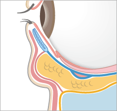 目の下のたるみとり：経結膜下脱脂法イラスト：目の下のたるみ（断面図）