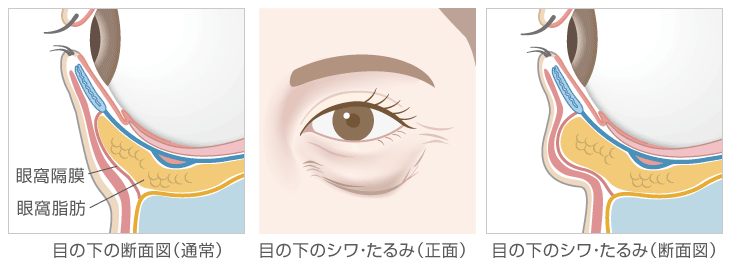 下眼瞼除皺術 クマ たるみ取り 脂肪含む ヒルズ美容クリニックは神奈川 湘南 藤沢の美容外科 美容皮膚科 形成外科