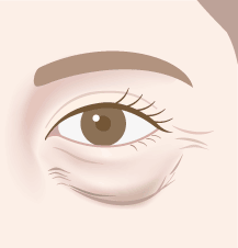 目の下のシワ・たるみとり：下眼瞼除皺術・下眼瞼脱脂術イラスト：目の下のしわ・たるみ（正面）