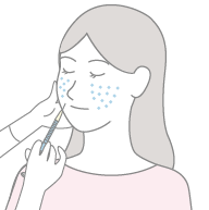 スキンボトックス注入