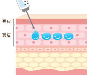 スキンボトックスの注入層
