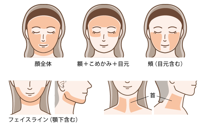 ソフウェーブ照射部位イラスト