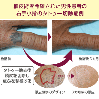 植皮術を希望された男性患者の右手小指のタトゥー切除