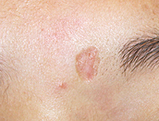 水疱瘡が凹んだ傷跡になった例