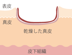 凹んだ傷跡の断面図