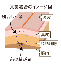 真皮縫合