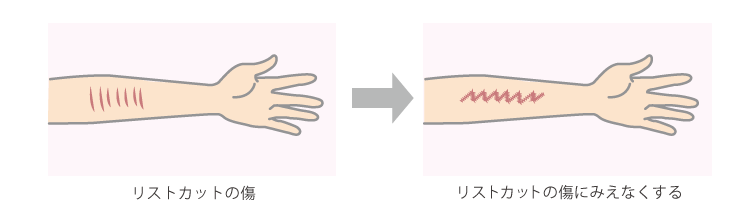 リストカットの傷